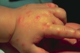 Allergic Reaction to Fire Ant Stings