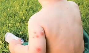 How to Treat Mosquito Bites on Toddlers: Safe Remedies & Prevention Tips How to Treat Mosquito Bites on Toddlers