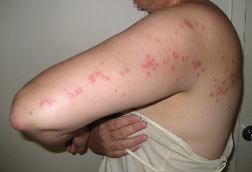 Bed Bug Bites in a Line