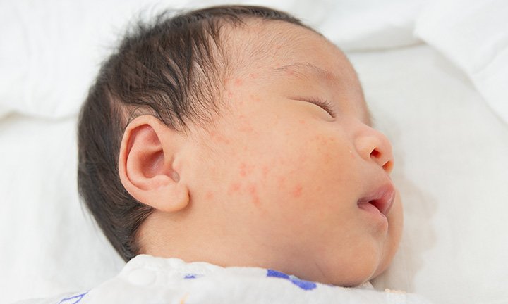 Bed Bug Bites on Baby Treatment: Safe Remedies and How to Protect Your Child Bed Bug Bites on Baby Treatment