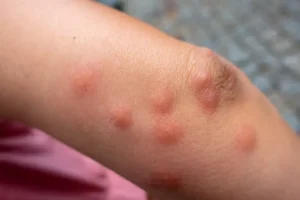 bed bug flea bites
