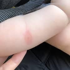 Bed Bug Bites on Baby Treatment: Safe Remedies and How to Protect Your Child bedbugbitesonbabytreatment ezgif.com gif to jpg converter