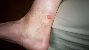 Bites Only on Ankles and Lower Legs: Common Causes and How to Stop Them Bites Only on Ankles and Lower Legs