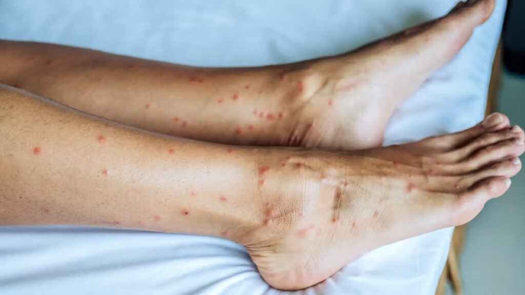 Bites Only on Ankles and Lower Legs: Common Causes and How to Stop Them Bites Only on Ankles and Lower Legs