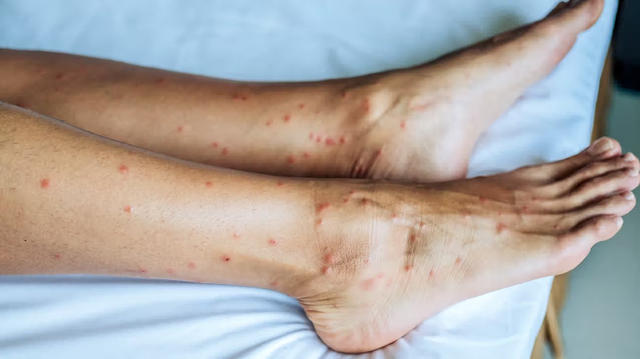 Bites Only on Ankles and Lower Legs
