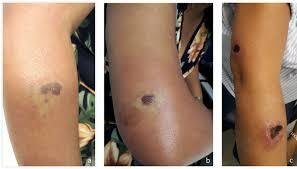 Brown Recluse Bite Stages