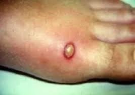 Brown Recluse Bite Symptoms Stages: How to Identify and Tr Brown Recluse Bite Symptoms Stages