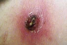 Brown Recluse Bite Symptoms Stages: How to Identify and Tr Brown Recluse Bite Symptoms Stages