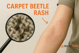 Carpet Beetle Rash: Causes, Symptoms, and Effective Treatment Tips Carpet Beetle Rash