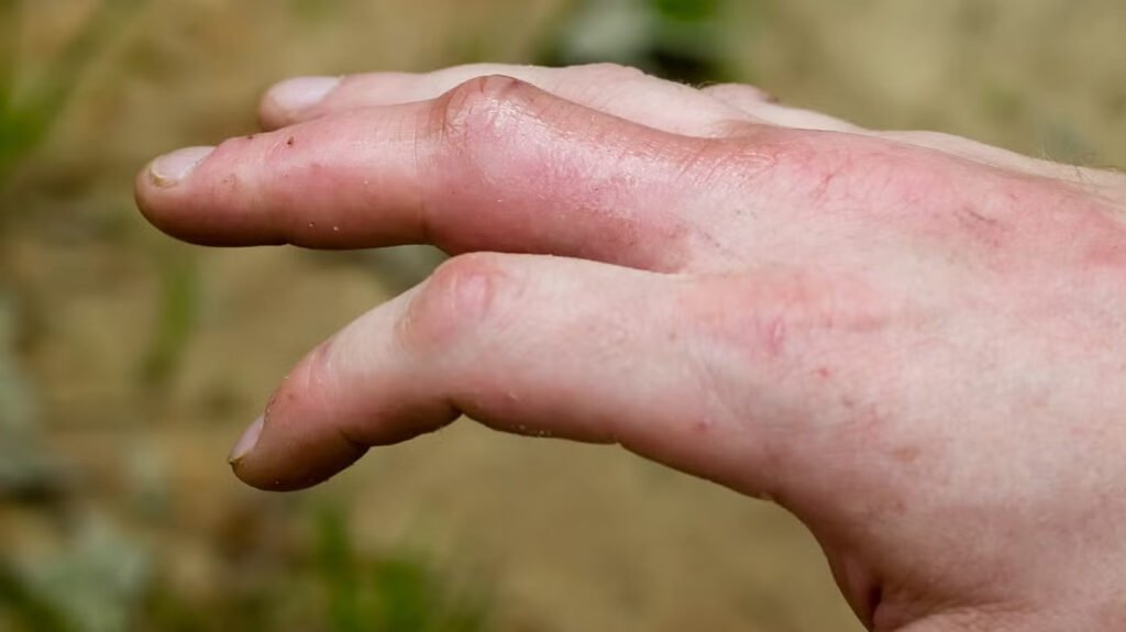 Centipede Bite Symptoms: Identification, Treatment & Recovery Guide Centipede Bite Symptoms