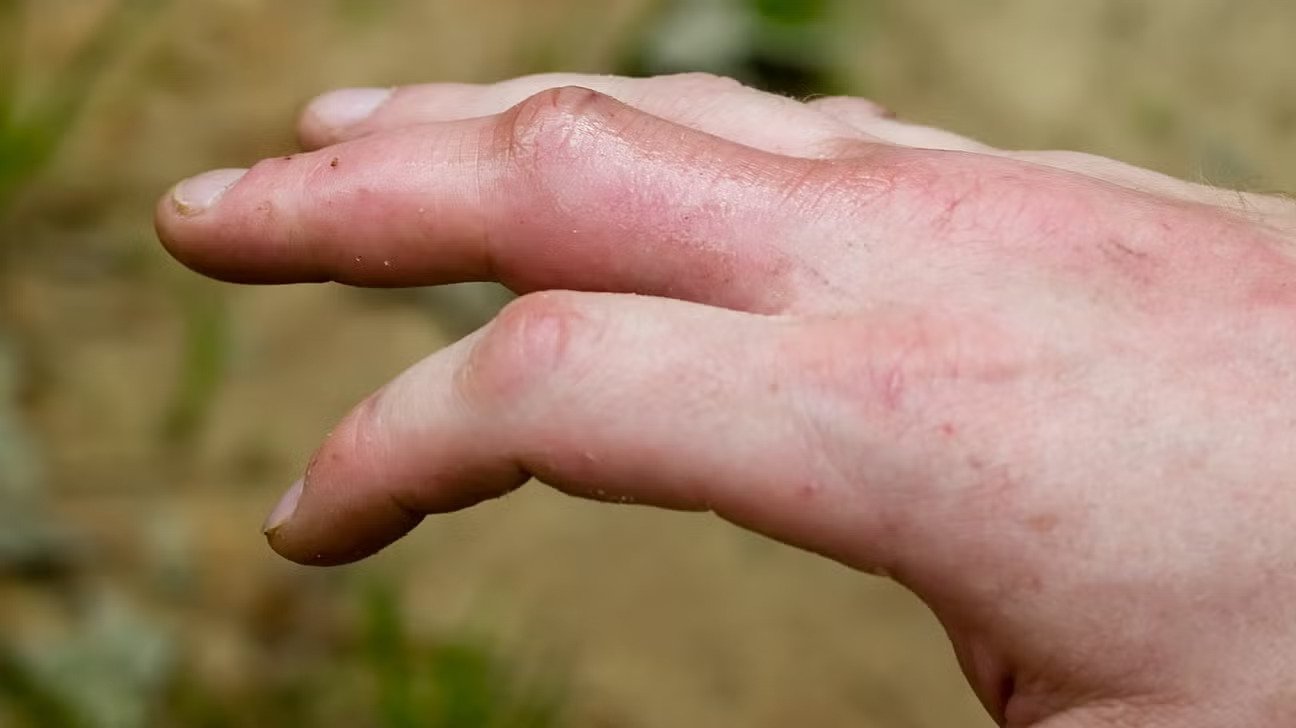 Centipede Bite Symptoms