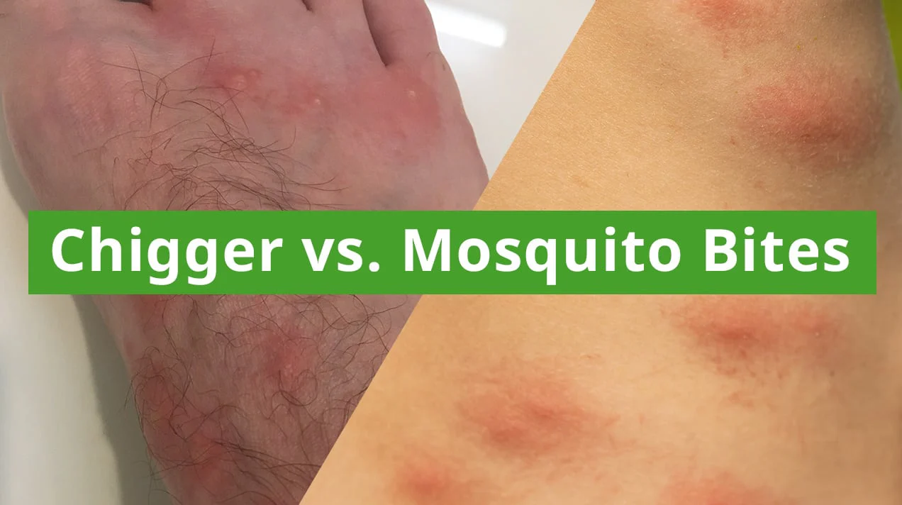chigger bites vs mosquito bites