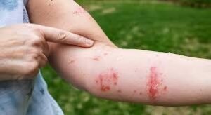 Does Rubbing Alcohol Help Poison Ivy? How It Works & When to Use It Safely Does Rubbing Alcohol Help Poison Ivy