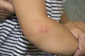 Mosquito Bite Blisters Treatment