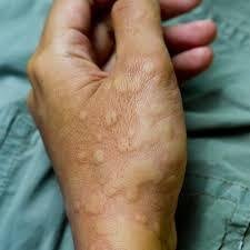 Hives vs Mosquito Bites: How to Tell the Difference and Treat Both Safely hivesvsmosquitobites ezgif.com gif to jpg converter (1)