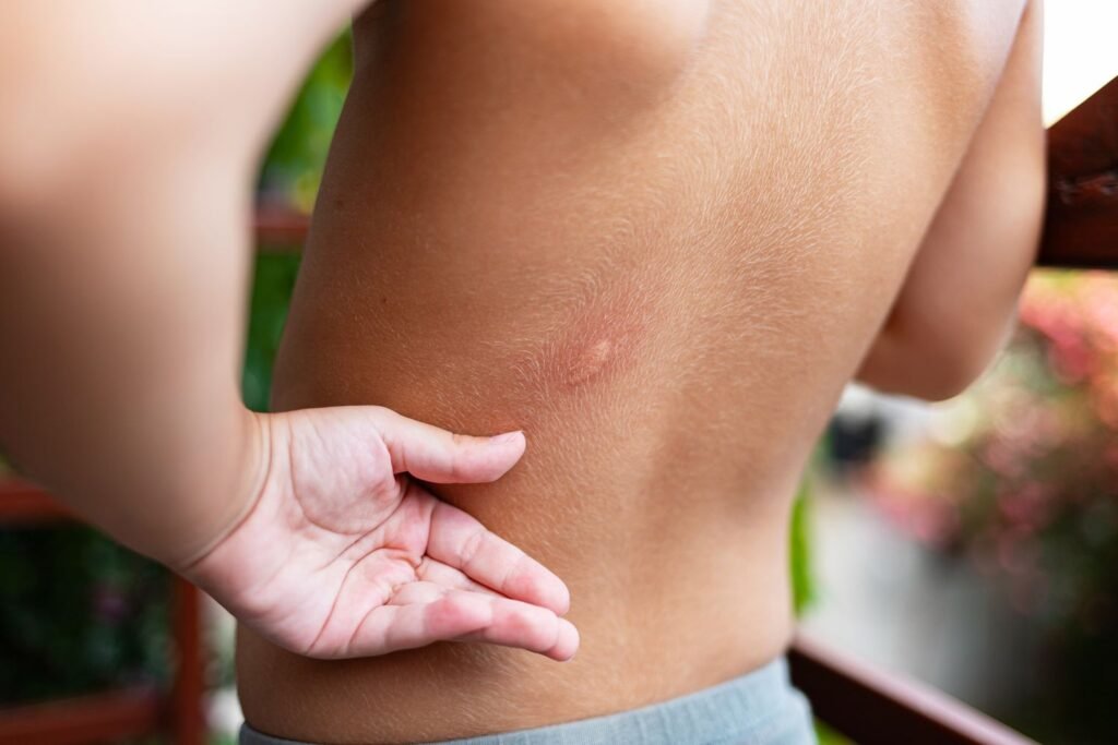 Home Remedies for Mosquito Bites: 7 Natural Ways to Stop Itching Fast What Do Bed Bug Bites Look Like