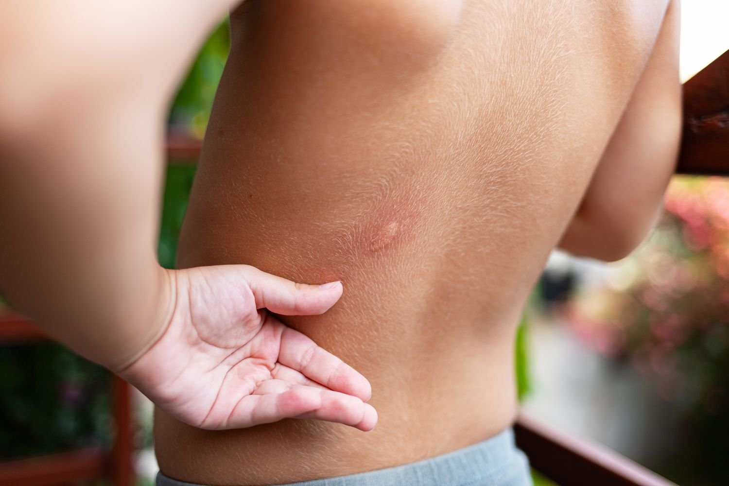 What Do Bed Bug Bites Look Like