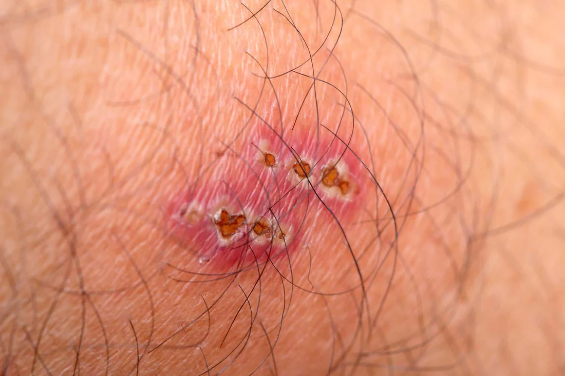 How Long Do Spider Bites Take to Heal