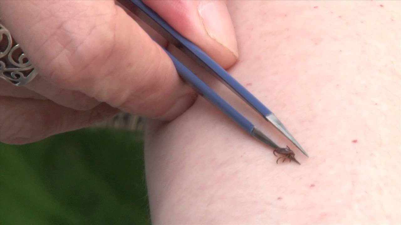 How to Remove Ticks from Humans Safely