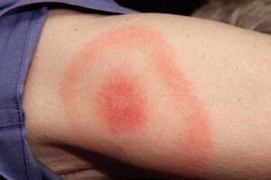 How to Safely Draw Out Infection from a Bug Bite: Effective Home and Medical Remedies How to Safely Draw Out Infection from a Bug Bite