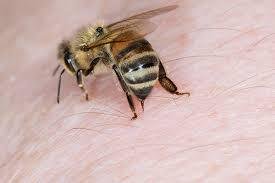 How Long Does Bee Sting Pain Last