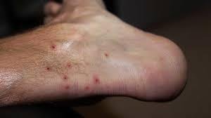How to Get Rid of Chigger Bites Fast: Effective Home Remedies and Treatments How to Get Rid of Chigger Bites Fast