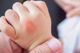 How to Treat Mosquito Bites on Toddlers