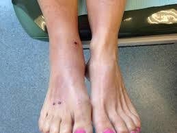 How to Treat a Stingray Sting: First Aid, Home Remedies, and When to See a Doctor How to Treat a Stingray Sting