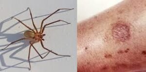 How to Treat an Infected Spider Bite Safely: Symptoms, Treatment & When to See a Docto How to Treat an Infected Spider Bite Safely