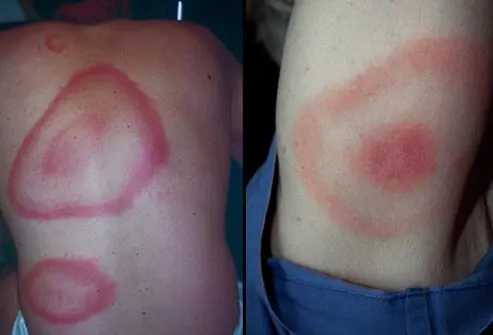 Lyme Disease Bullseye Rash