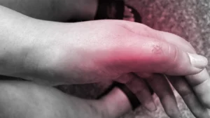 Lymphangitis from a Bug Bite: Causes, Symptoms, and When to See a Doctor Lymphangitis from a Bug Bite