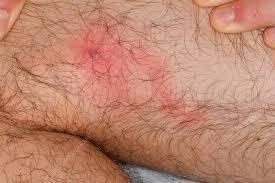 Lymphangitis from a Bug Bite