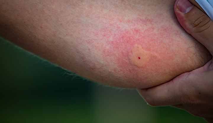 Mosquito Bite Marks on Skin Removal: Natural Remedies and Effective Treatments Mosquito Bite Marks on Skin Removal