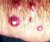 Pustules from Fire Ant Bites: Causes, Treatment & Prevention Tips Pustules from Fire Ant Bites