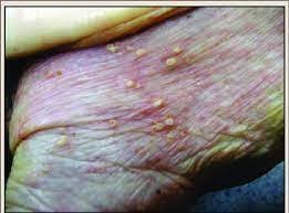 Pustules from Fire Ant Bites: Causes, Treatment & Prevention Tips Pustules from Fire Ant Bites