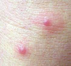 Scabies vs Chigger Bites