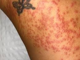 Sea Lice Bites Treatment: Symptoms, Relief, and Prevention Tips from Experts Sea Lice Bites Treatment