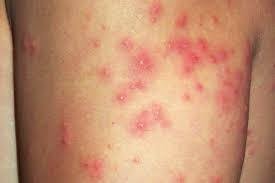 Sea Lice Bites Treatment: Symptoms, Relief, and Prevention Tips from Experts How to Get Rid of Poison Ivy Rash Fast