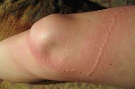 How to Get Rid of Poison Ivy Rash Fast