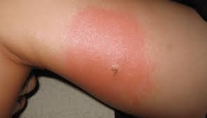 Spider Bite Treatment for Children and Toddlers