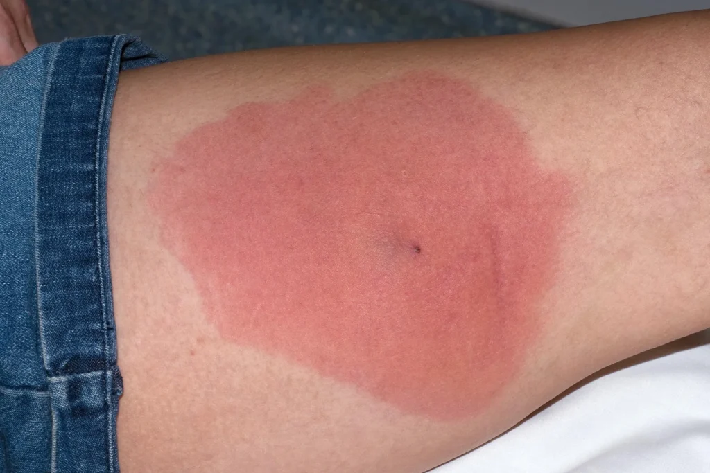 Spider Bites and Staph Infections: Causes, Risks & Care Spider Bites and Staph Infections