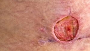 Staph vs. MRSA from a Bug Bite: A Visual Guide to Spotting the Difference Staph vs. MRSA from a Bug Bite