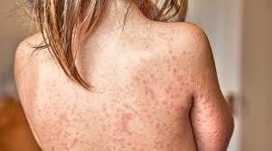 How Long Does Poison Ivy Last? Symptoms, Treatment & Healing Timeline How Long Does Poison Ivy Last