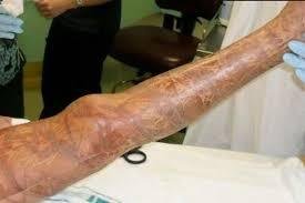 How to Treat a Stingray Sting