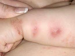 West Nile Virus Symptoms