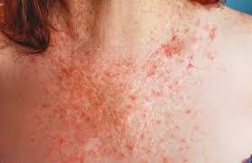 West Nile Virus Symptoms