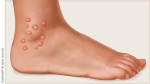 What Do Chigger Bites Look Like? Symptoms, Pictures, and Treatment Tips What Do Chigger Bites Look Like