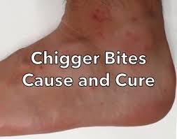 What Do Chigger Bites Look Like
