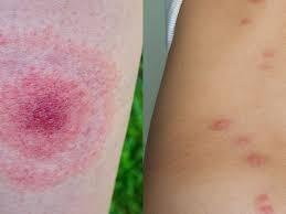 What’s Biting Me in My Garden? Common Garden Pests and How to Protect Yourself What’s Biting Me in My Garden