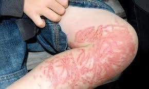 Portuguese Man O' War Sting Treatment: First Aid and New Scientific Consensus Portuguese Man O